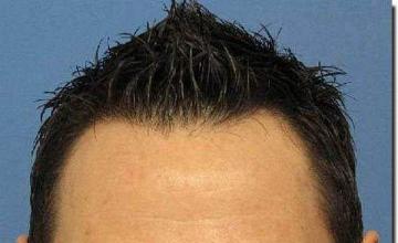 Hair restoration procedure results