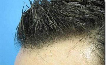 Hair restoration procedure results