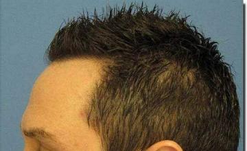 Hair restoration procedure results