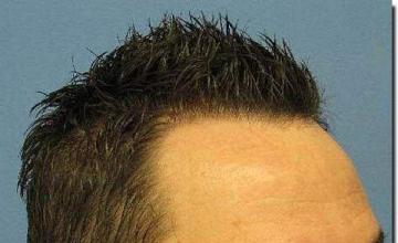 Hair restoration procedure results