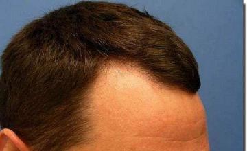 Hair restoration procedure results