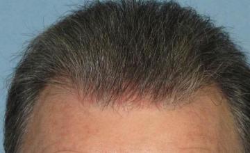 Hair restoration surgery before and after photos