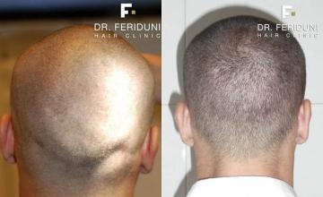 Hair restoration procedure before and after pictures