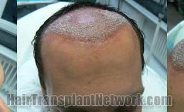 Hair transplantation surgery before and after photos