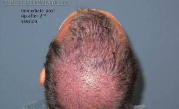 Hair restoration procedure before and after pictures