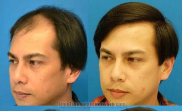 Hair transplantation surgery before and after pictures