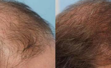 Hair restoration procedure before and after pictures