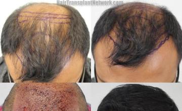 Hair restoration procedure before and after results