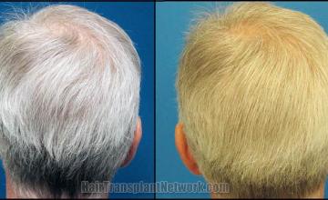 Before and after surgical hair restoration images