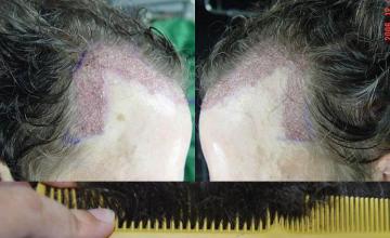 Hair transplantation surgery before and after pictures