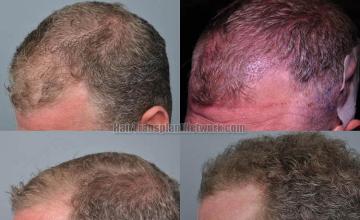 Hair transplantation surgery before and after pictures