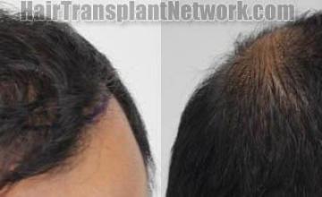 Hair transplantation surgery before and after images