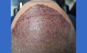 Surgical hair transplantation result photographs