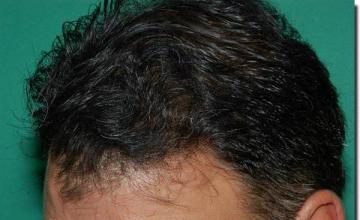 Hair restoration procedure results