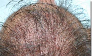 Hair restoration procedure results