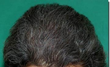 Hair restoration procedure results