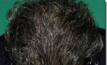 Hair restoration procedure results