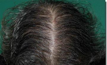 Hair restoration procedure results