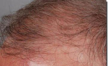 Hair restoration procedure results