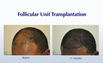 Hair transplantation surgery before and after images