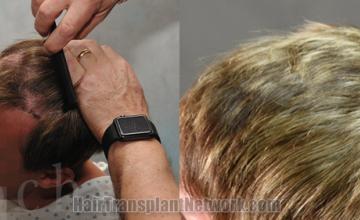 Before and after hair transplantation result photographs