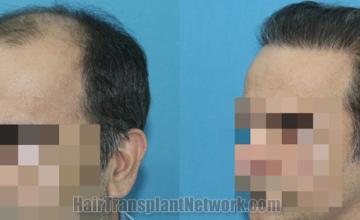 Before and after hair transplantation result photographs