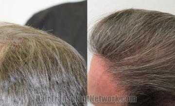 Before and after hair transplantation result photographs