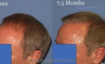 Hair transplantation surgery before and after images