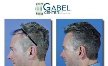 Hair restoration surgery before and after photos