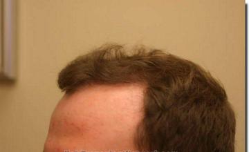 Hair restoration procedure results