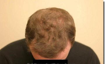 Hair restoration procedure results