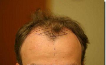 Hair restoration procedure results