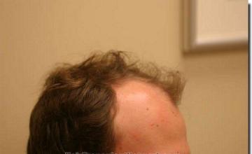 Hair restoration procedure results