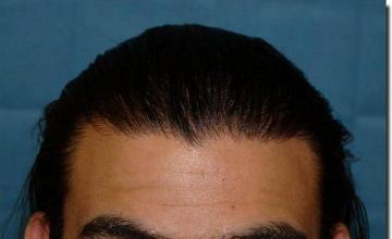 Hair restoration procedure results