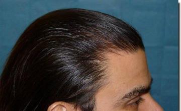 Hair restoration procedure results