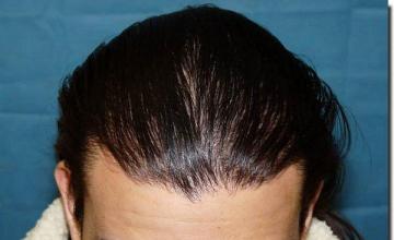 Hair restoration procedure results