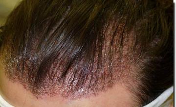 Hair restoration procedure results