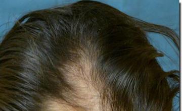 Hair restoration procedure results