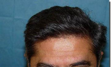 Hair restoration procedure results