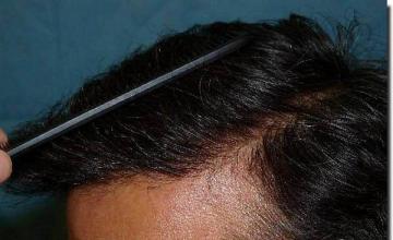 Hair restoration procedure results