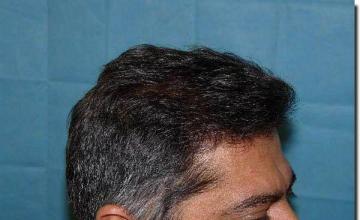 Hair restoration procedure results