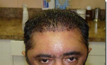 Hair restoration procedure results