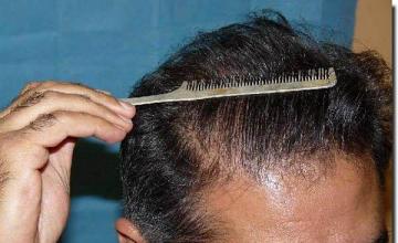 Hair restoration procedure results