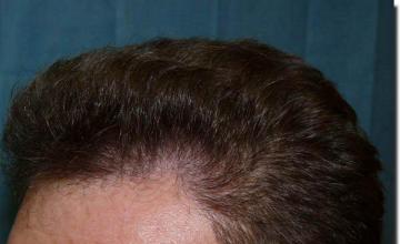 Hair restoration procedure results