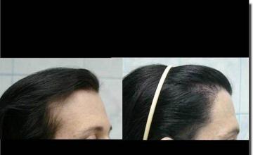 Hair restoration procedure results