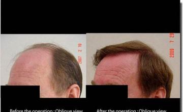 Hair restoration procedure results