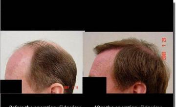 Hair restoration procedure results