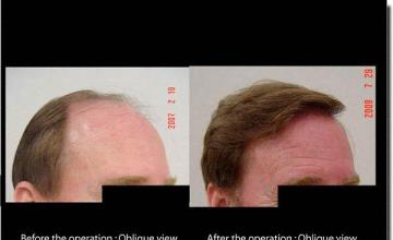 Hair restoration procedure results