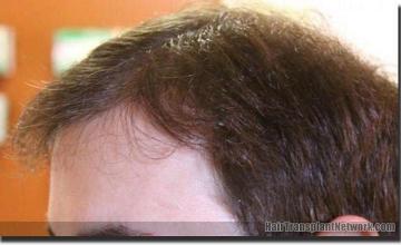 Hair restoration procedure results