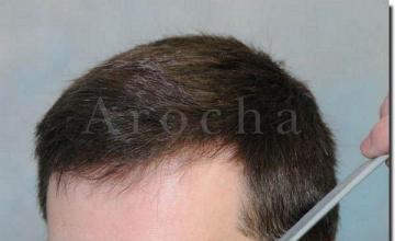 Hair restoration procedure results